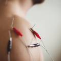 How Does Dry Needling Help Relieve Muscle Pain?